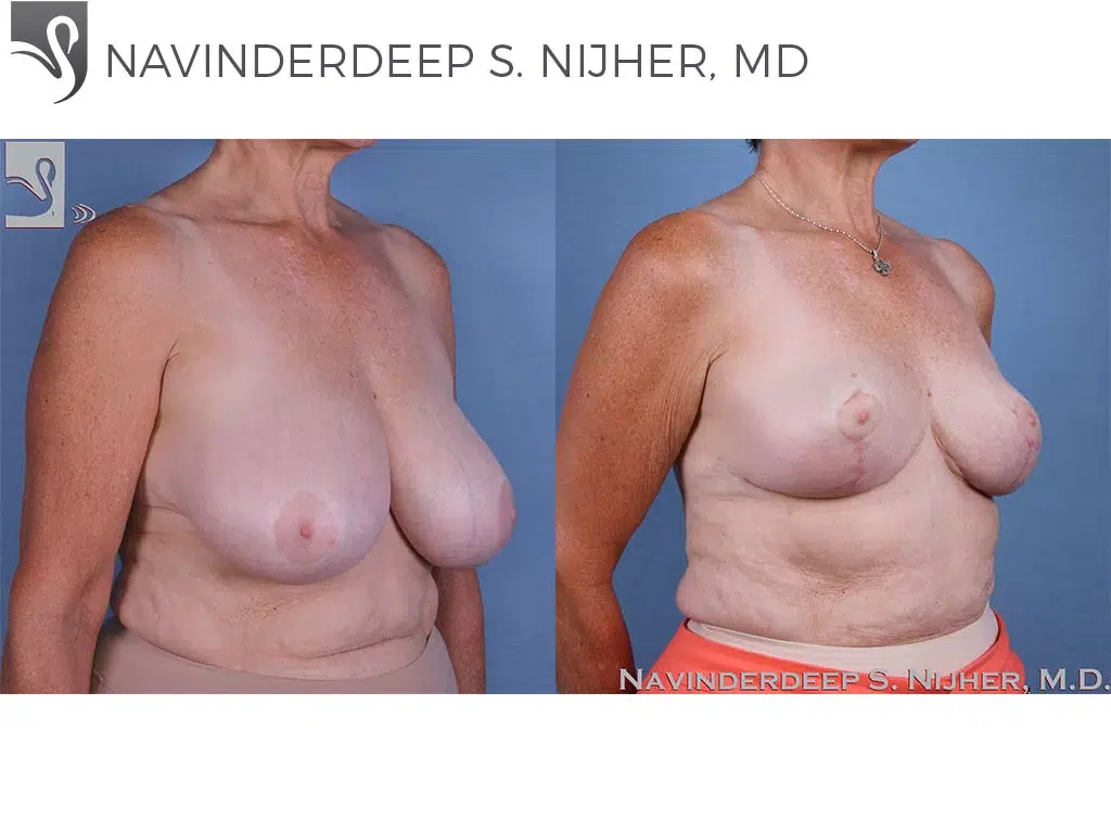 Before and After Image: Female Breast Reduction Case #59813 - right-front-oblique