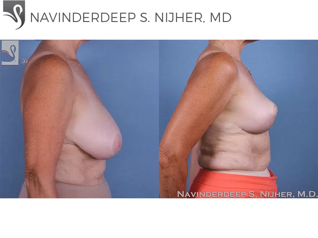 Before and After Image: Female Breast Reduction Case #59813 - right-side