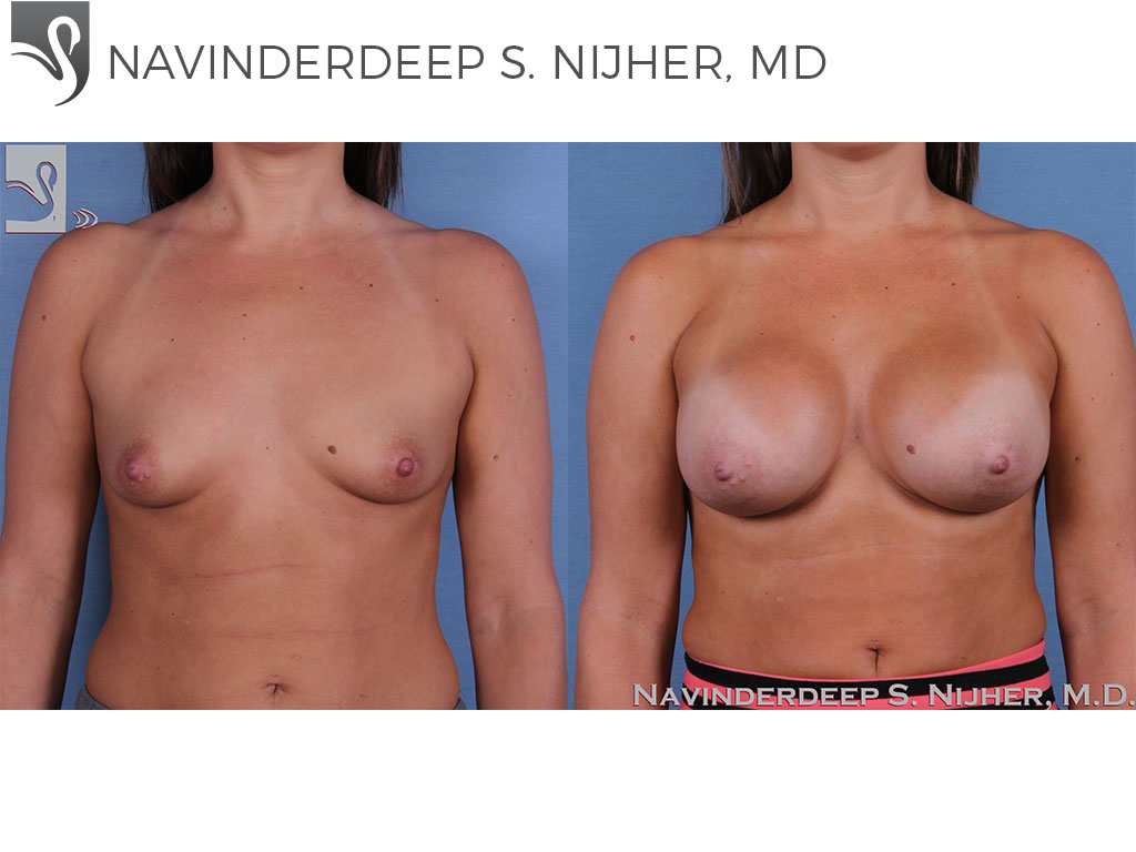 Before and After Image: Breast Augmentation Case #59976 - front