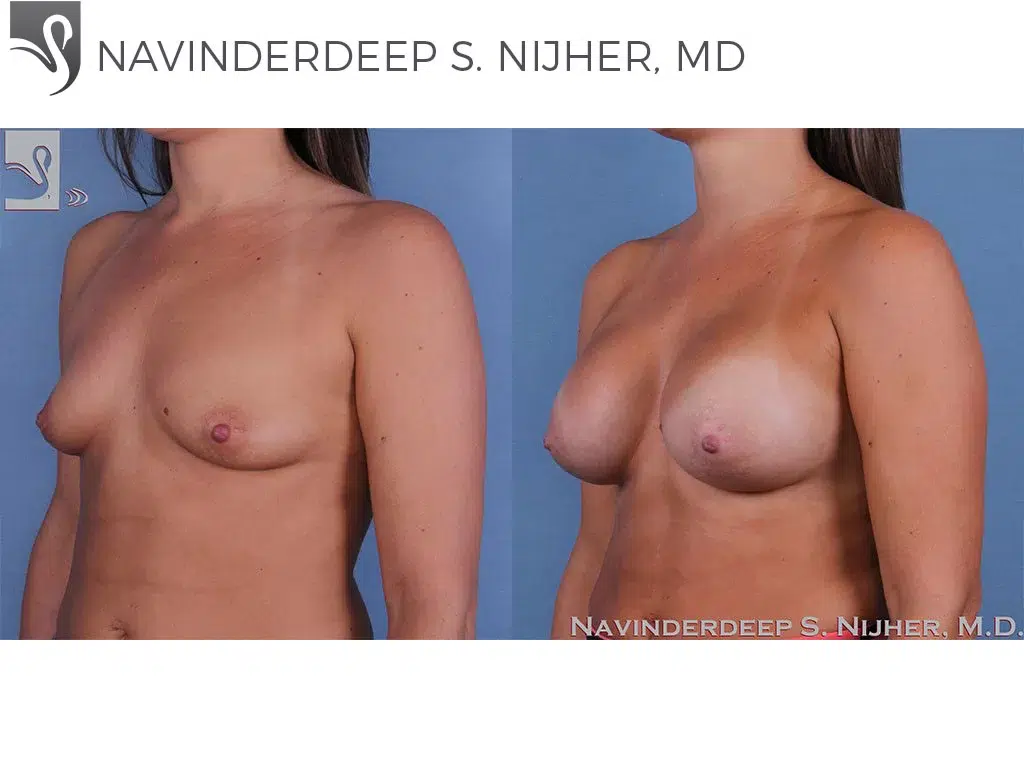 Before and After Image: Breast Augmentation Case #59976 - left-front-oblique