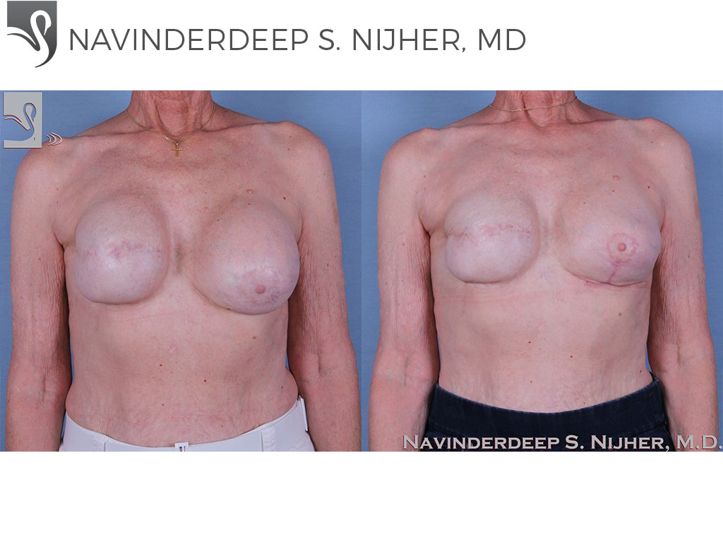 Before and After Image: Breast Reconstruction Case #60006 - front