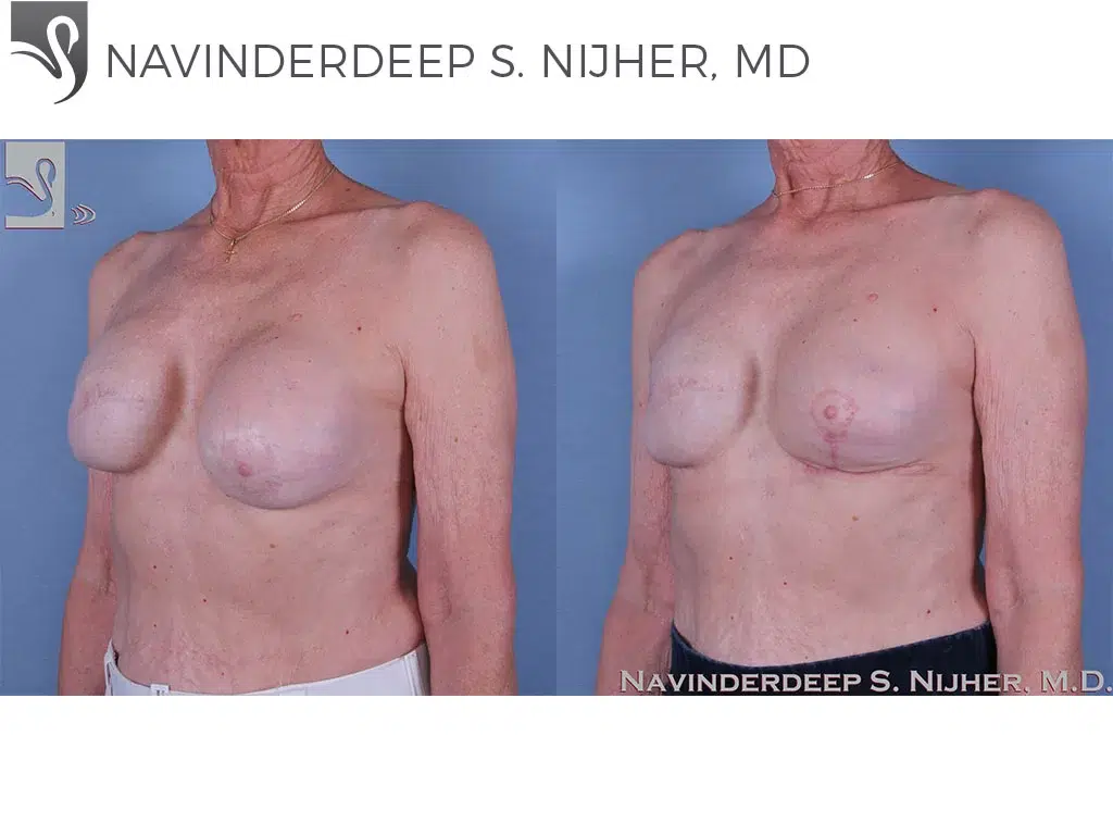 Before and After Image: Breast Reconstruction Case #60006 - left-front-oblique