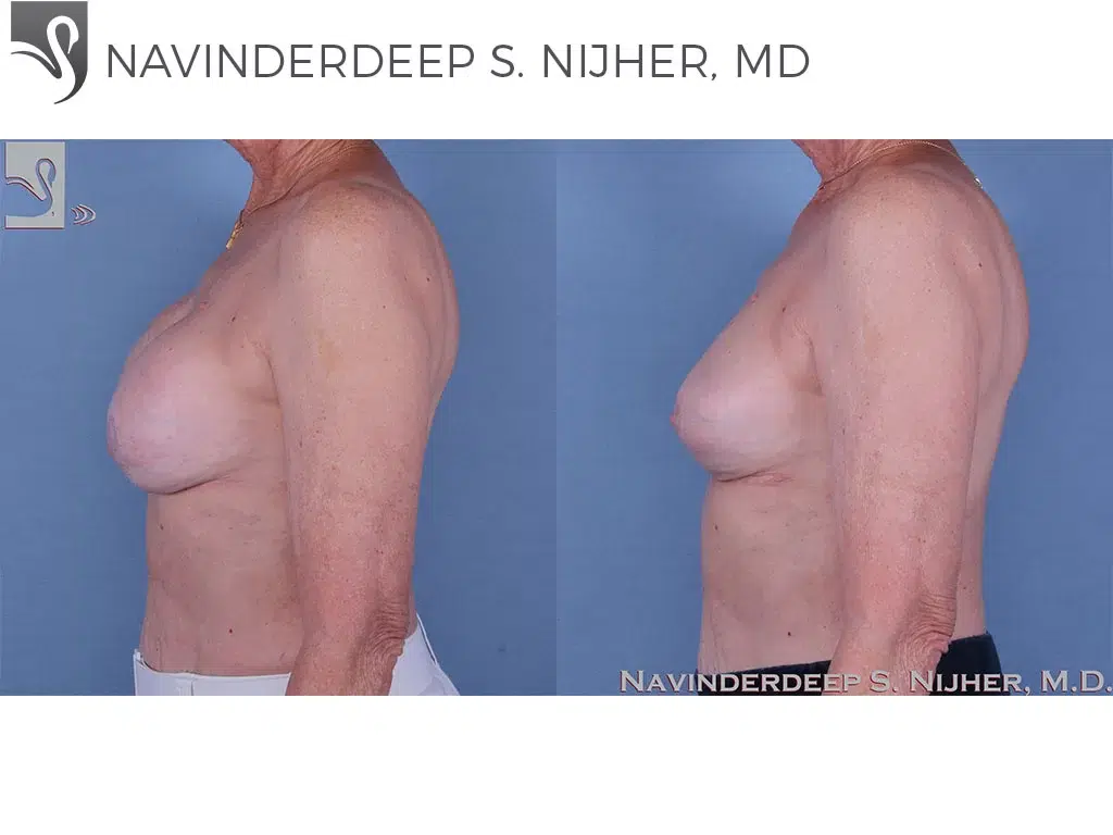 Before and After Image: Breast Reconstruction Case #60006 - left-side
