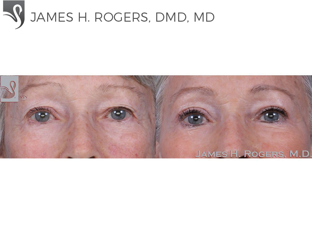 Before and After Image: Eyelid Surgery Case #60032 - front