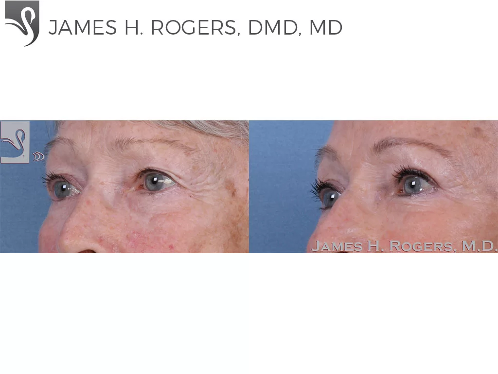 Before and After Image: Eyelid Surgery Case #60032 - left-front-oblique