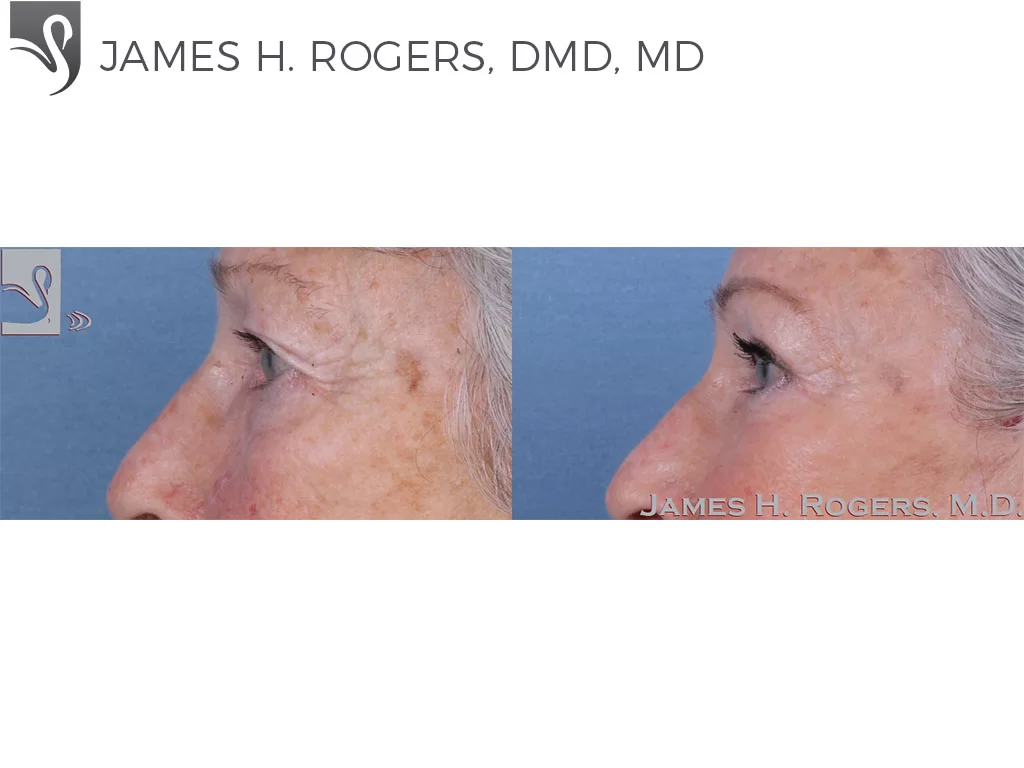 Before and After Image: Eyelid Surgery Case #60032 - left-side