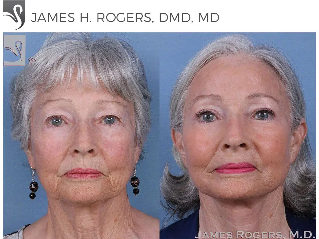 Before and After Image: Face Lift Case #60032 - front