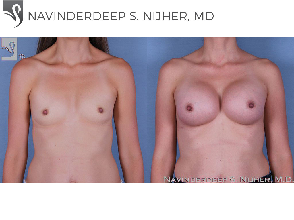 Before and After Image: Breast Augmentation Case #60148 - front