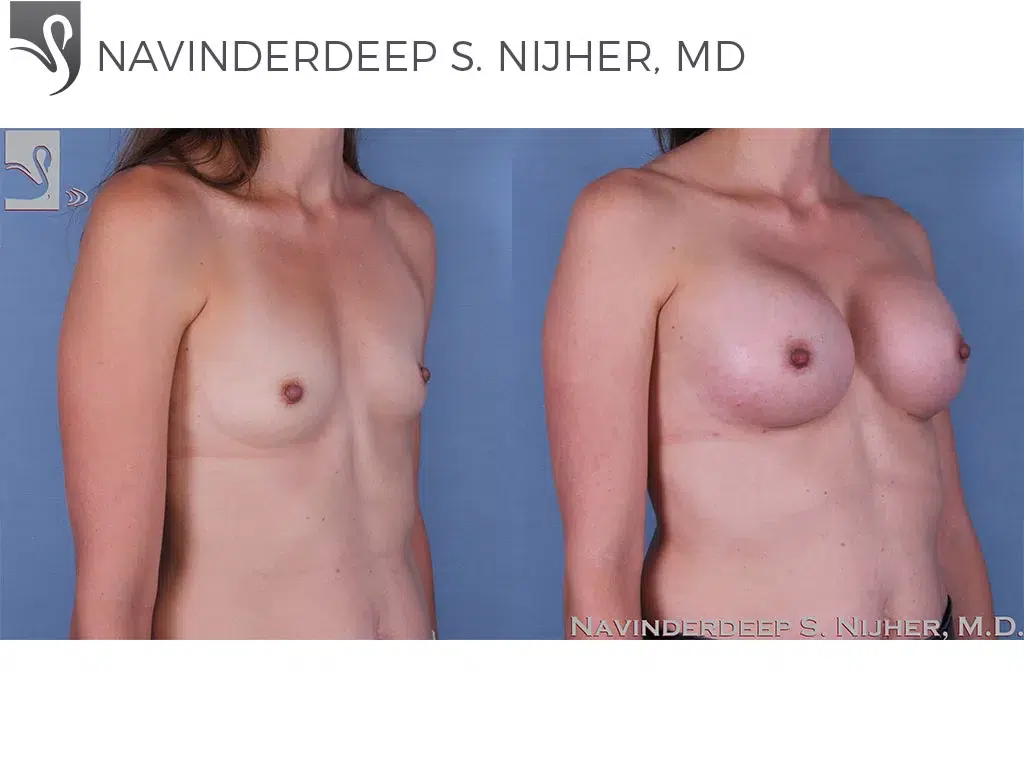 Before and After Image: Breast Augmentation Case #60148 - right-front-oblique