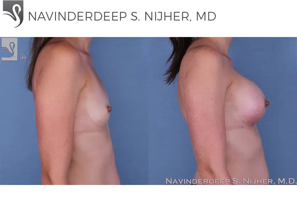 Before and After Image: Breast Augmentation Case #60148 - right-side