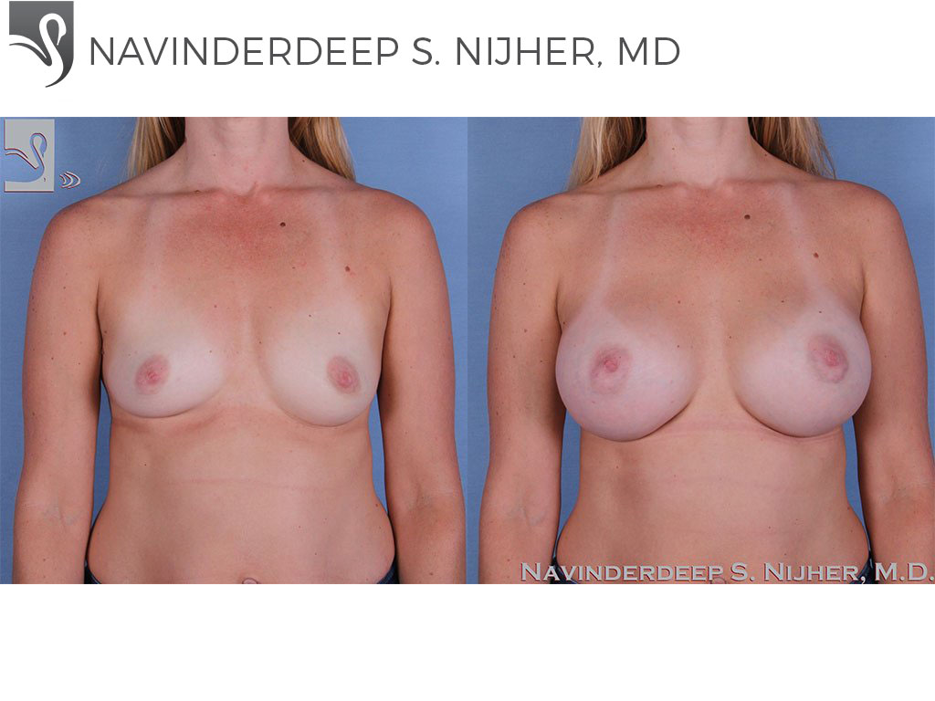 Before and After Image: Breast Augmentation Case #60160 - front