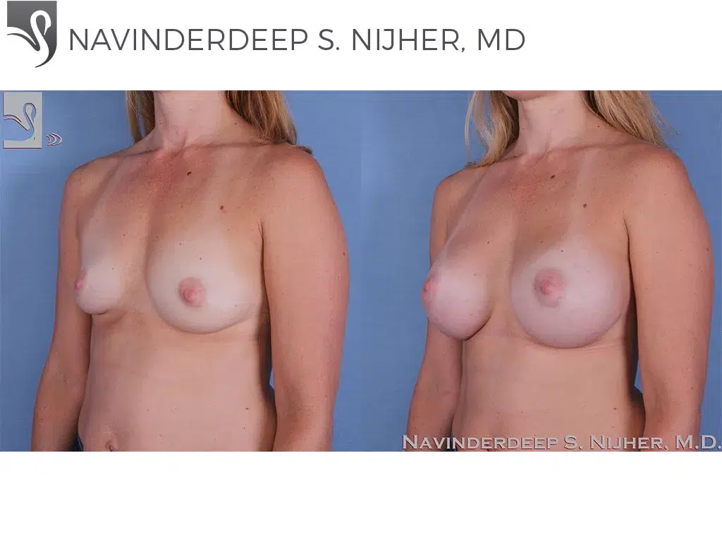 Before and After Image: Breast Augmentation Case #60160 - left-front-oblique