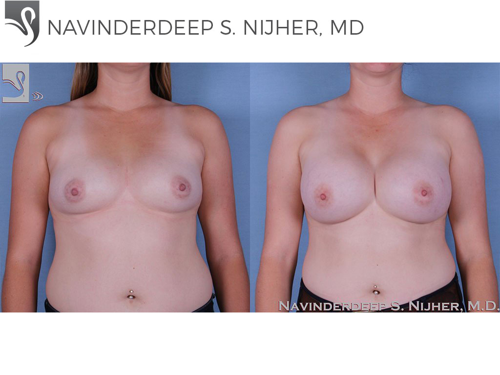 Before and After Image: Breast Augmentation Case #60216 - front