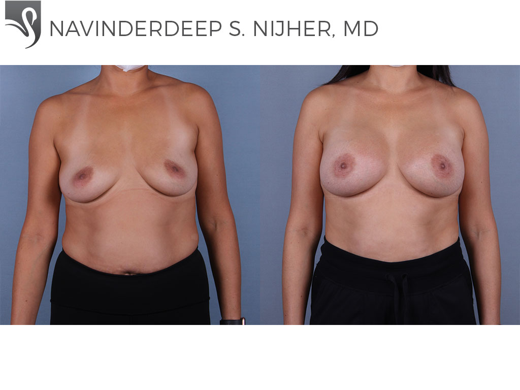 Before and After Image: Breast Augmentation Case #60253 - front