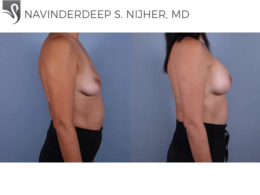 Before and After Image: Breast Augmentation Case #60253 - right-side