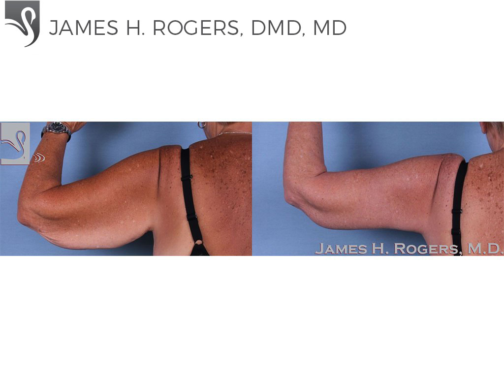 Before and After Image: Arm Lift Case #60263 - back