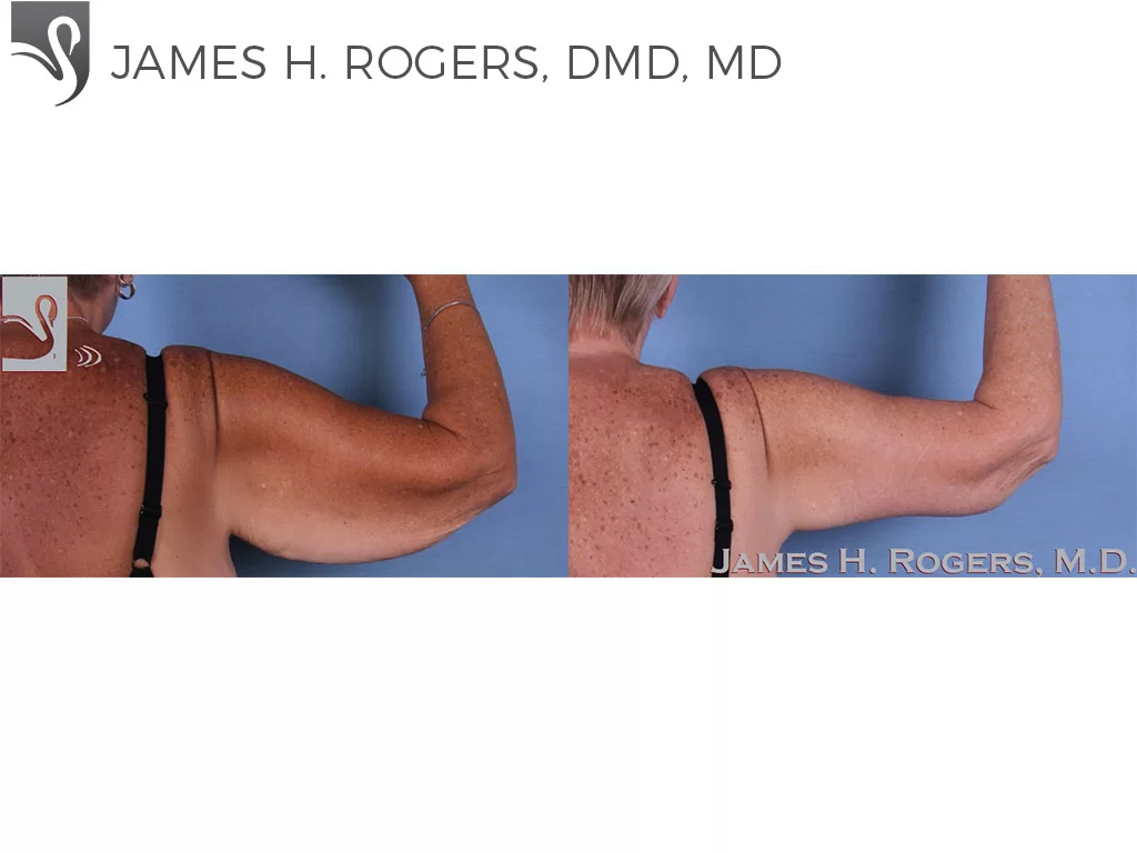 Before and After Image: Arm Lift Case #60263 - back