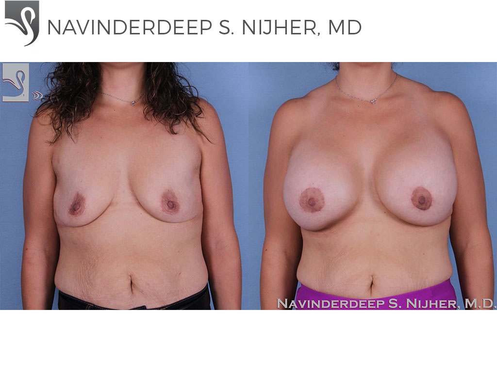 Before and After Image: Breast Augmentation Case #60321 - front