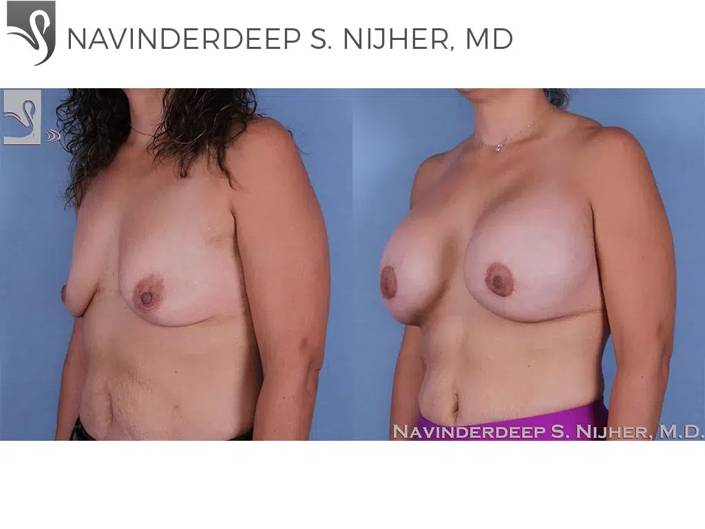 Before and After Image: Breast Augmentation Case #60321 - left-front-oblique