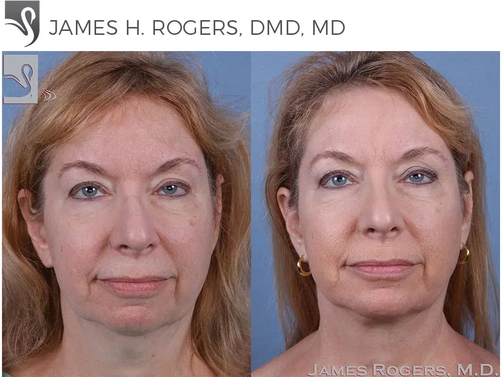 Before and After Image: Facial Implants Case #60340