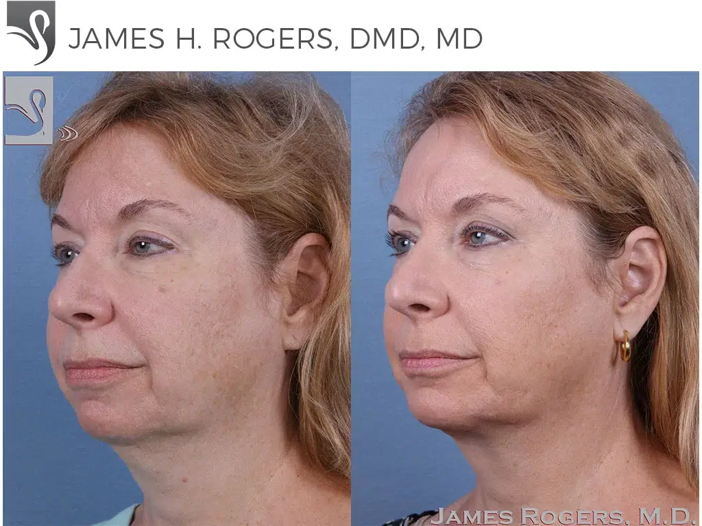 Before and After Image: Facial Implants Case #60340 - left-front-oblique