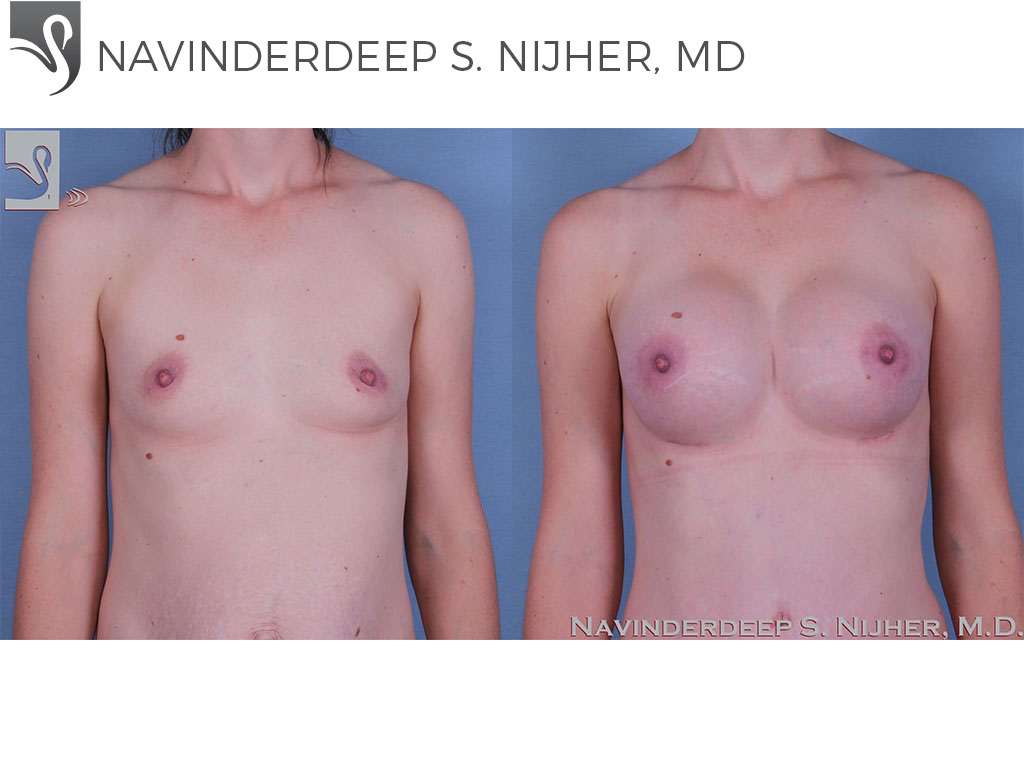 Before and After Image: Breast Augmentation Case #60351 - front