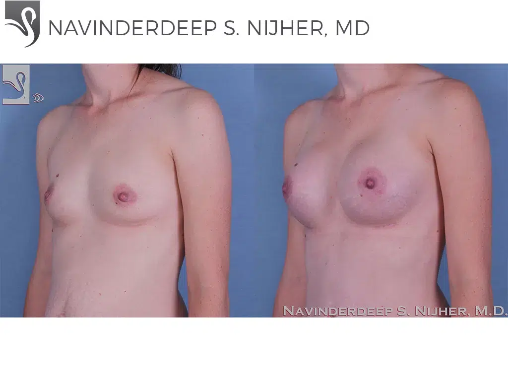 Before and After Image: Breast Augmentation Case #60351 - left-front-oblique