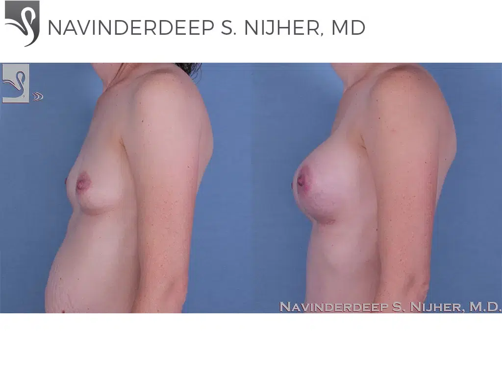 Before and After Image: Breast Augmentation Case #60351 - left-side
