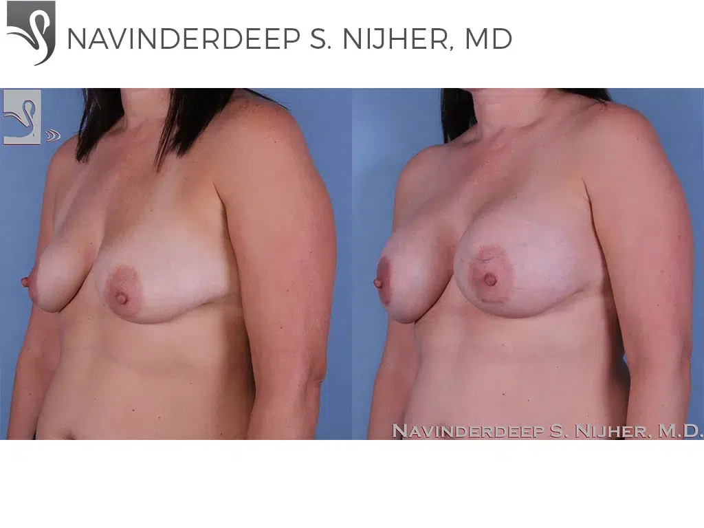 Before and After Image: Breast Augmentation Case #60389 - left-front-oblique