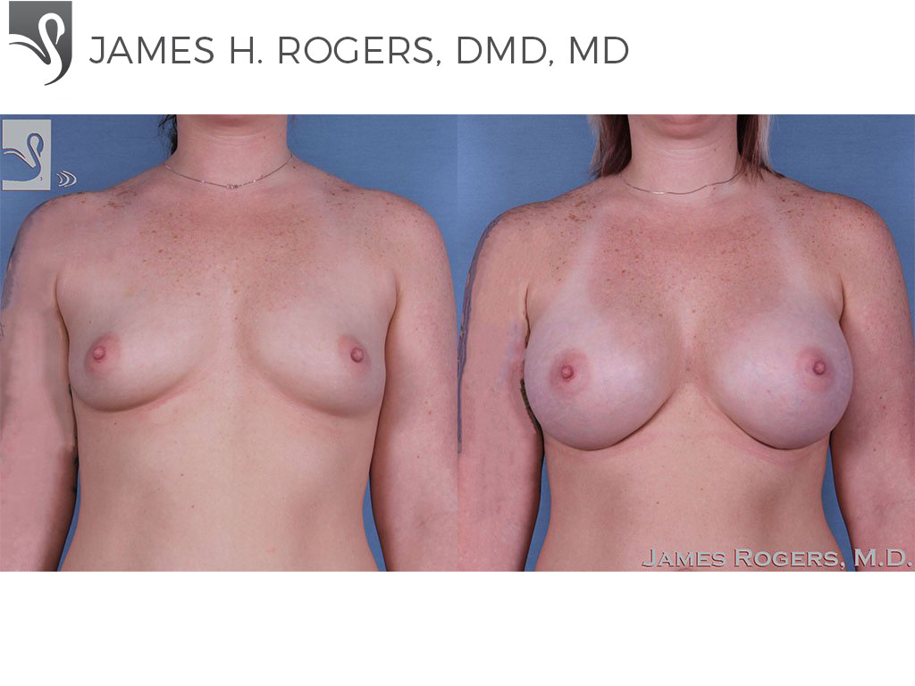 Before and After Image: Breast Augmentation Case #60414 - front