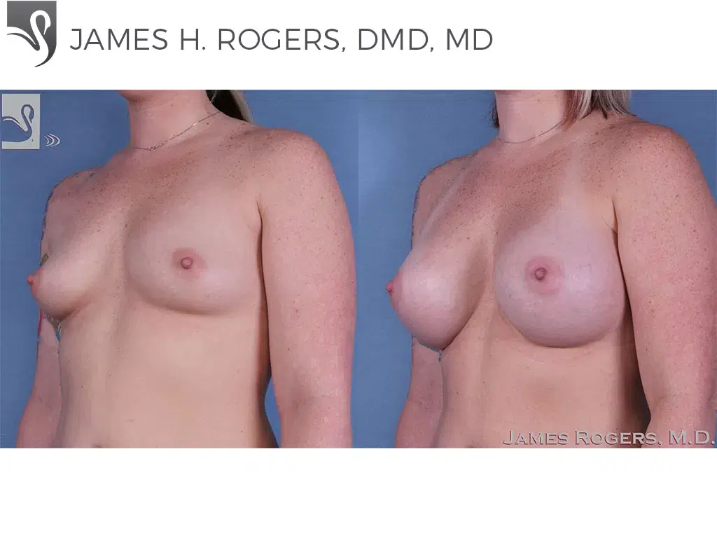 Before and After Image: Breast Augmentation Case #60414 - left-front-oblique