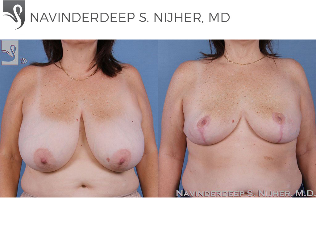 Before and After Image: Female Breast Reduction Case #60528 - front