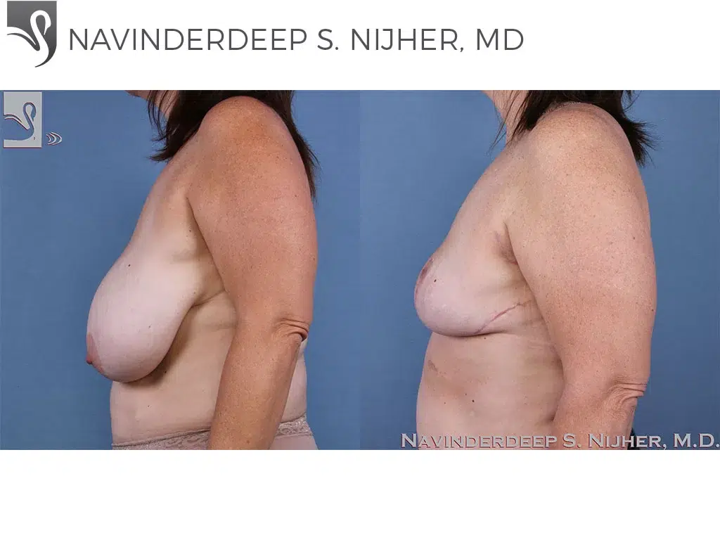 Before and After Image: Female Breast Reduction Case #60528 - left-side