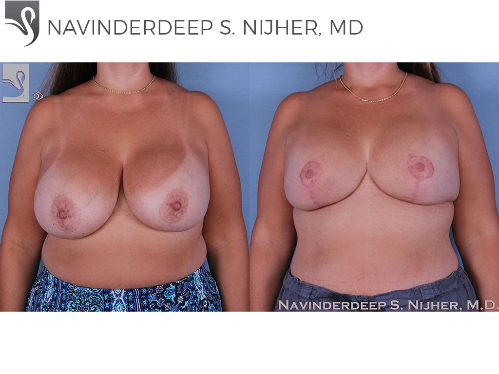 Before and After Image: Breast Revisions Case #60567 - front