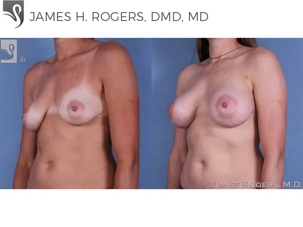 Before and After Image: Breast Augmentation Case #60705 - left-front-oblique