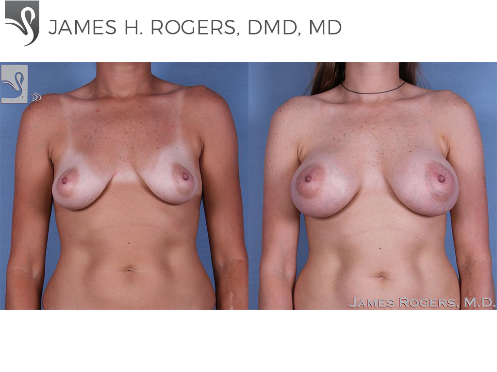 Before and After Image: Breast Augmentation Case #60705 - front