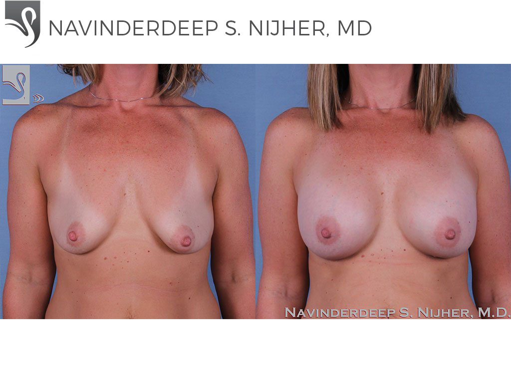 Before and After Image: Breast Augmentation Case #60724 - front