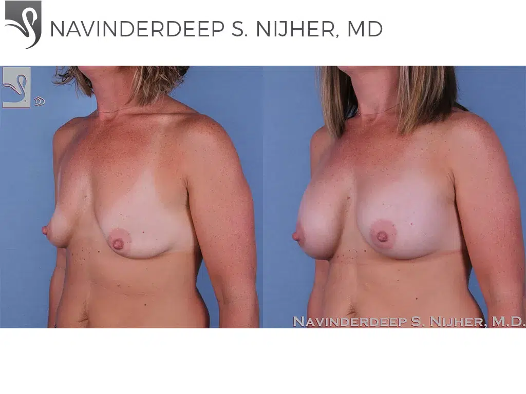 Before and After Image: Breast Augmentation Case #60724 - left-front-oblique