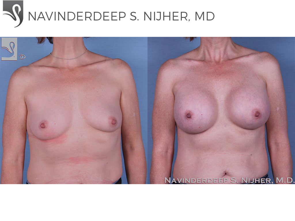 Before and After Image: Breast Augmentation Case #60761 - front