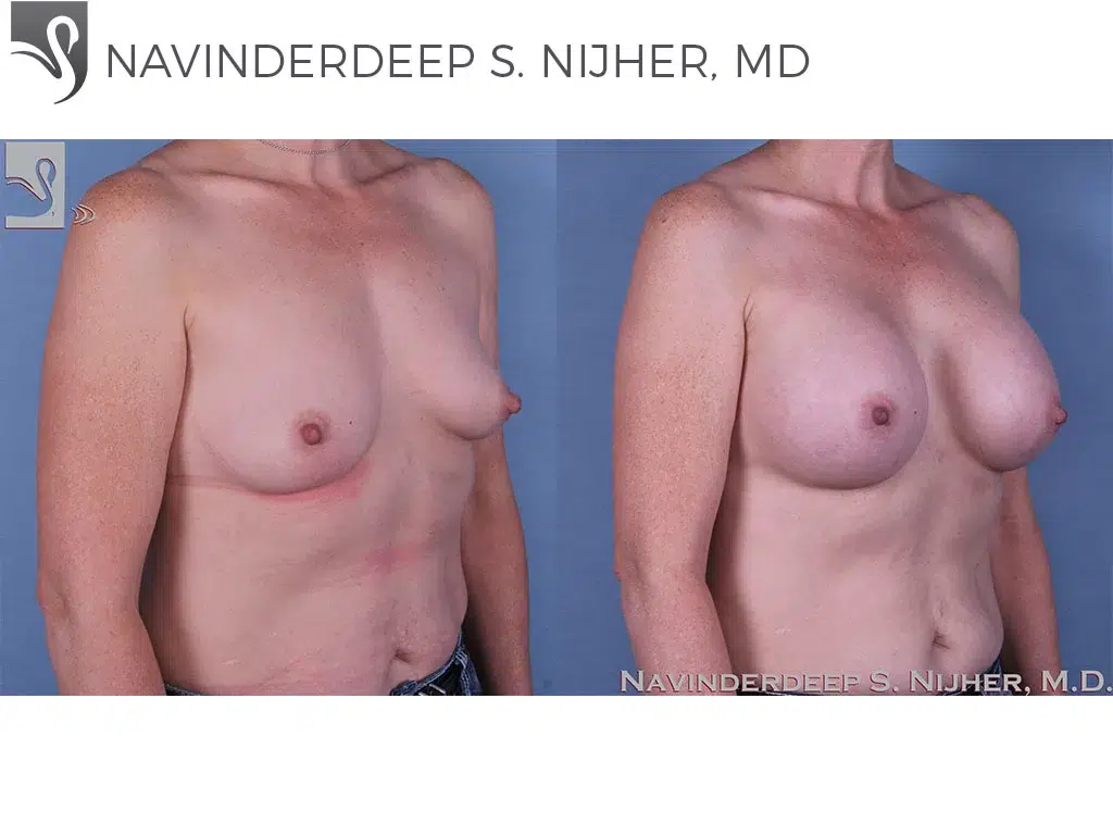 Before and After Image: Breast Augmentation Case #60761 - right-front-oblique