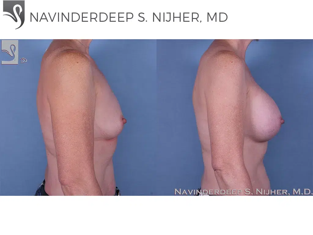 Before and After Image: Breast Augmentation Case #60761 - right-side