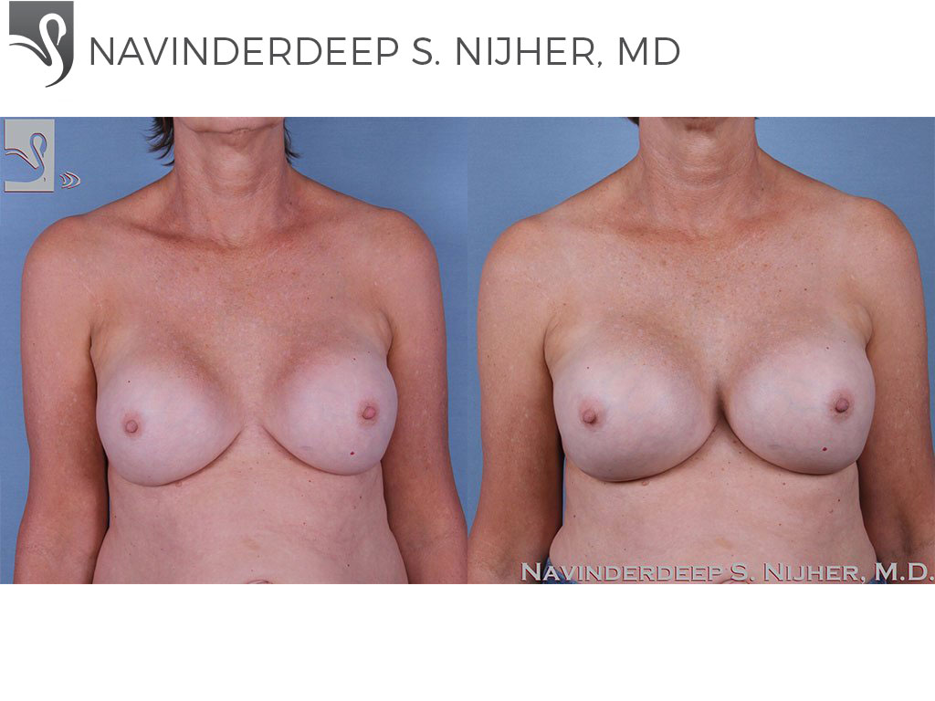Before and After Image: Breast Revisions Case #60881 - front