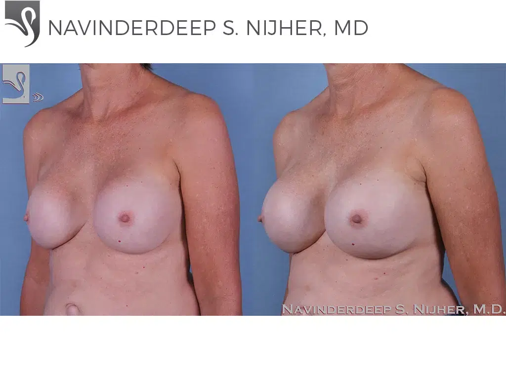 Before and After Image: Breast Revisions Case #60881 - left-front-oblique