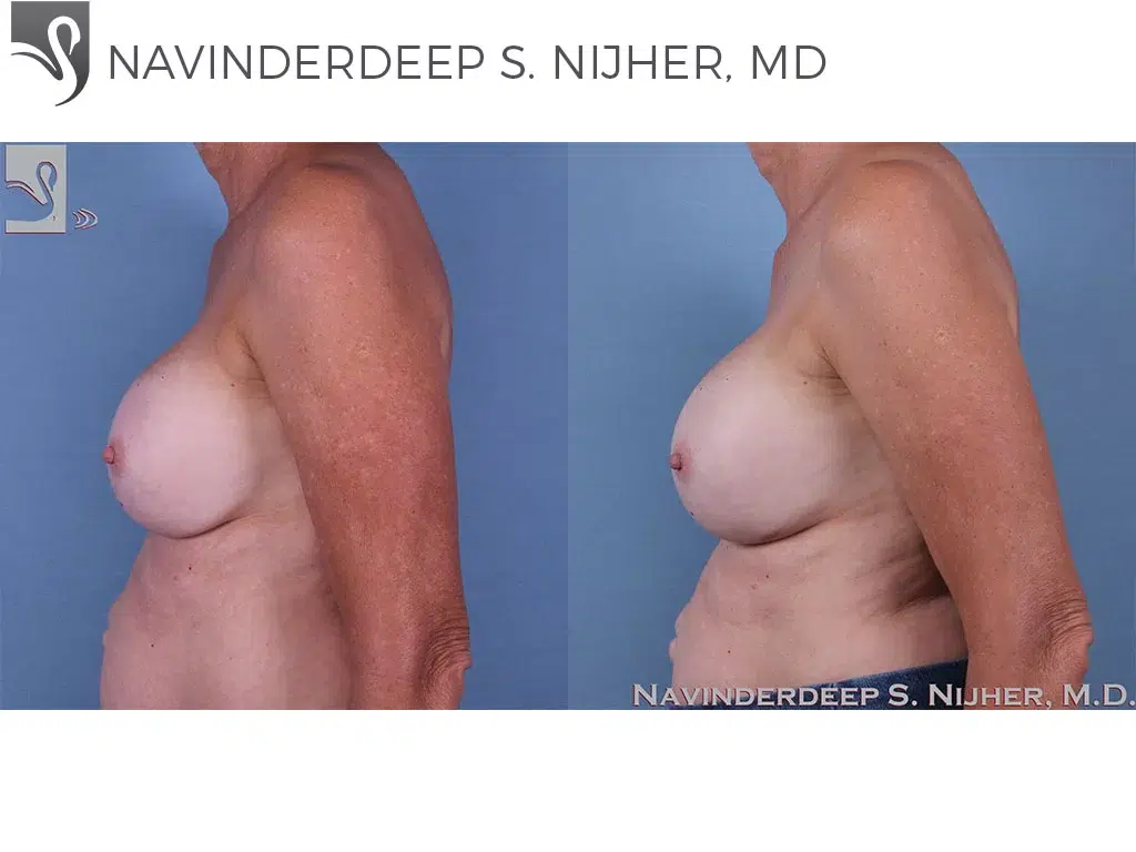 Before and After Image: Breast Revisions Case #60881 - left-side