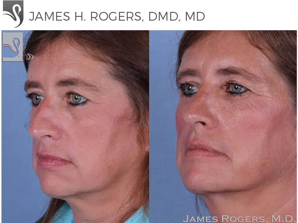 Before and After Image: Rhinoplasty Case #60893 - 