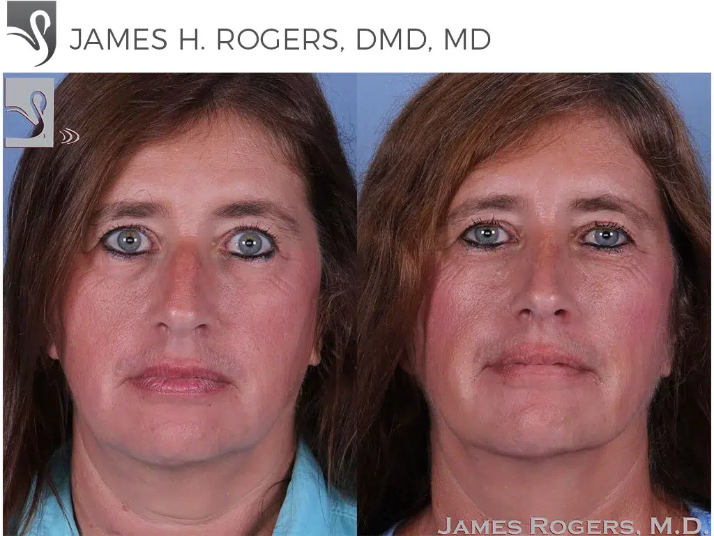 Before and After Image: Rhinoplasty Case #60893 - 