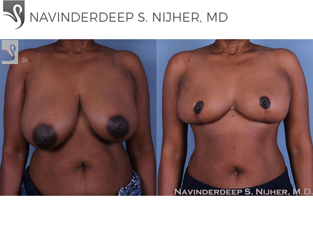 Before and After Image: Female Breast Reduction Case #60954 - front