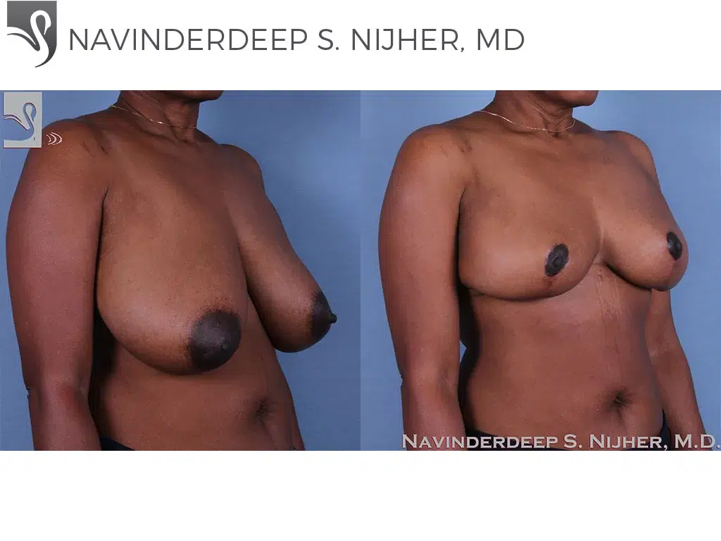 Before and After Image: Female Breast Reduction Case #60954 - right-front-oblique