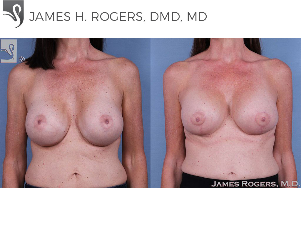 Before and After Image: Breast Revisions Case #61009 - front