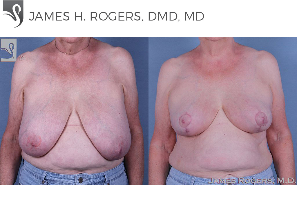 Before and After Image: Female Breast Reduction Case #61041 - front